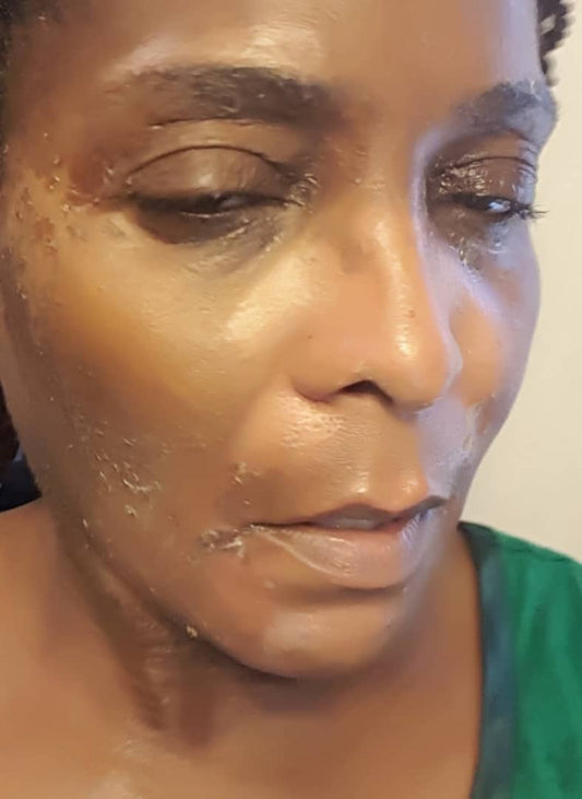 How I healed my Lupus damaged Skin with Organic Vegan Skincare line.